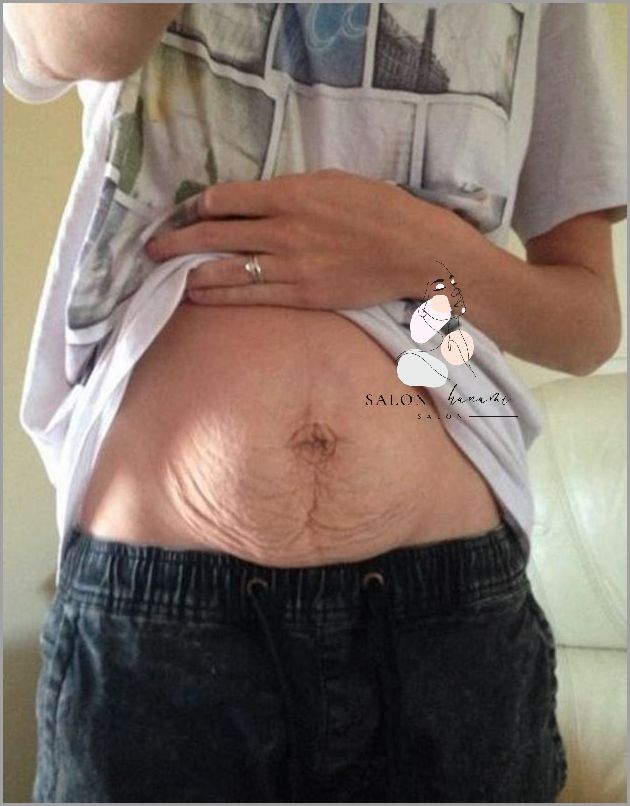 Przełomowe Zabiegi Na Brzuch Po Ciąży!