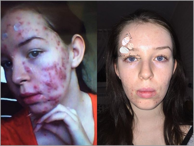 Leki Na Trądzik Od Dermatologa - Przegląd Niesamowitych Efektów!