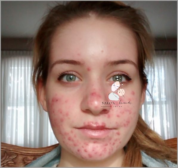 Leki Na Trądzik Od Dermatologa - Przegląd Niesamowitych Efektów!