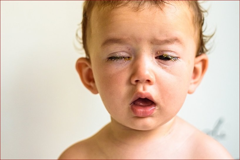 Zielona wydzielina z oka - poznaj przerażające przyczyny tego niepokojącego objawu